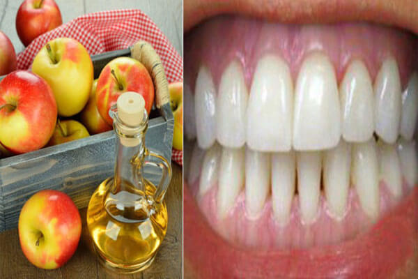 tác dụng của giấm táo với hàm răng